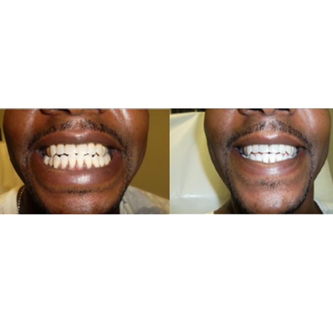 Professional Quality Home Teeth Whitening Kit